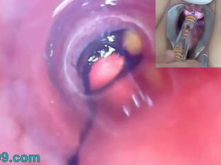 Suono e inserimento: esame della vescica di una donna matura con un endoscopio penetrante (Fotocamera, Palline)